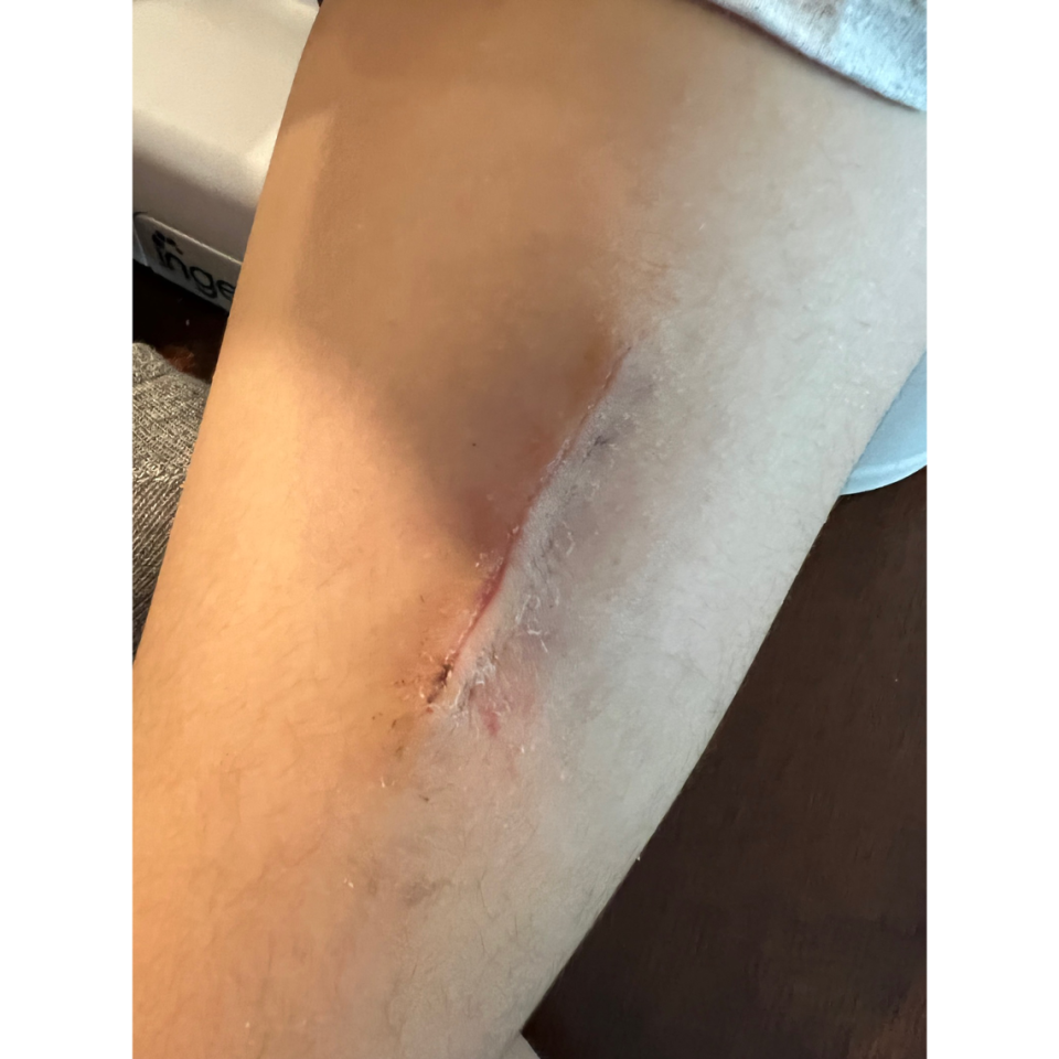 This photo shows a scar one of the children represented in the lawsuit was left with after having to undergo surgery to remove the infection.