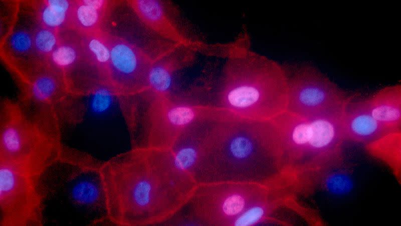 This undated fluorescence-colored microscope image made available by the National Institutes of Health in September 2016 shows a culture of human breast cancer cells.