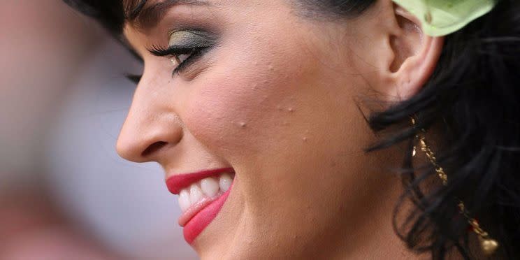 A la cantante Katy Perry los granitos le salen durante las giras <em>“por el estrés y porque duermo poco”.</em> Para sus apariciones en público suele aplicarse maquillaje para taparse, aunque no es recomendable hacerlo. (Foto: Getty)