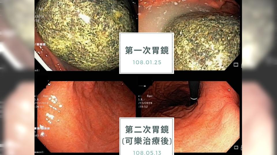 老翁喝可樂治療前後對照的胃鏡照片。圖／翻攝平安葉治威聯合診所臉書