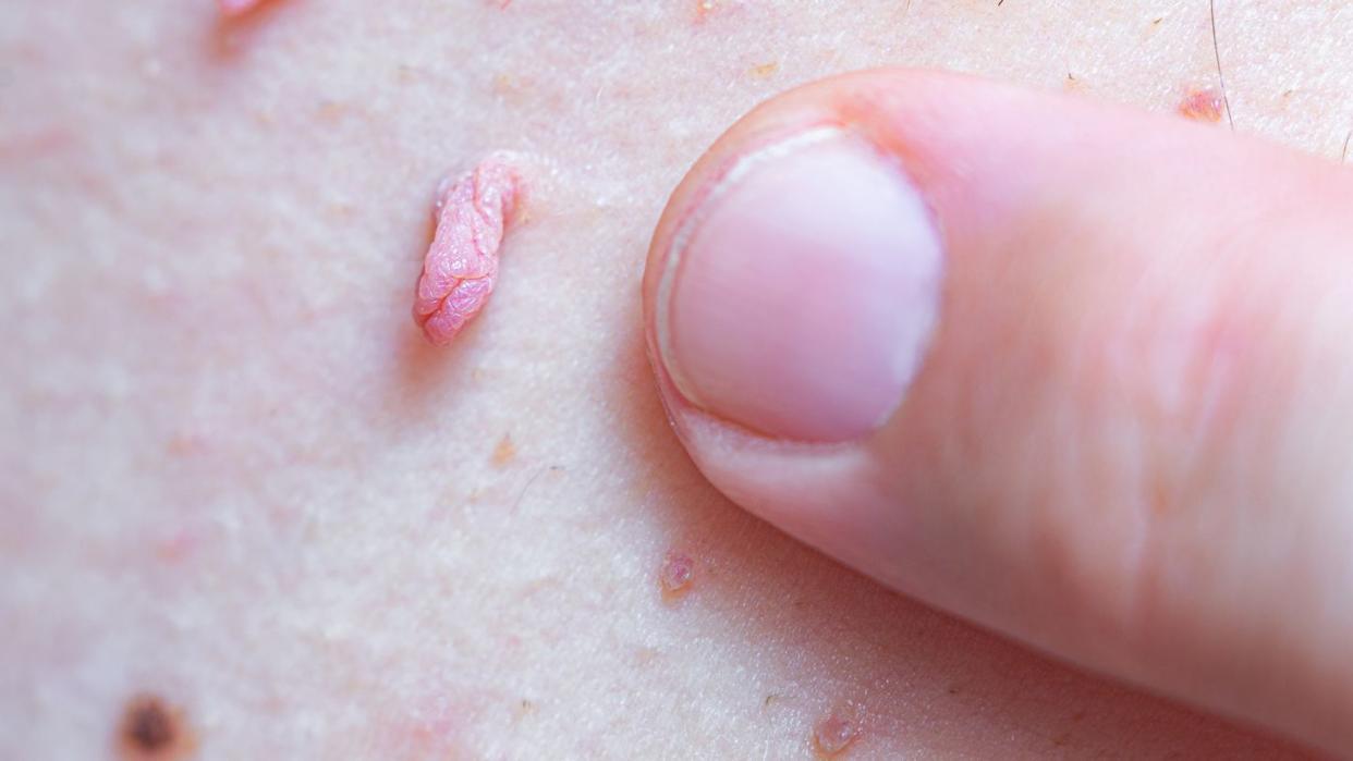 skin tag on a white person's skin