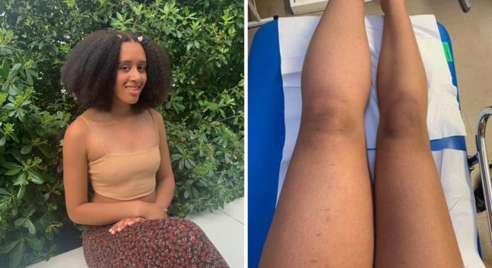 Didi Okoh was diagnosed with lymphoedema, the same condition as Linda Nolan, in 2016 when she was just 13 years old. (Didi Okoh/SWNS)