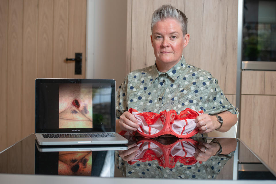 Lynne pictured with one of the bras which caused her wound. [Photo: SWNS]