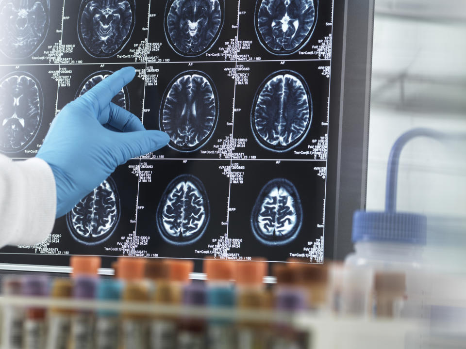 Gloved hand pointing to brain scans