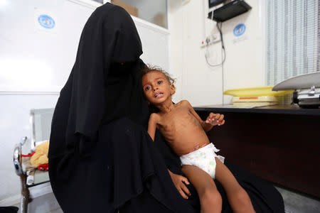 Mother of malnourished Ferial Elias, 2, holds her at the malnutrition treatment ward of al-Thawra hospital in Hodeidah, Yemen November 3, 2018. Picture taken November 3, 2018. REUTERS/Abduljabbar Zeyad