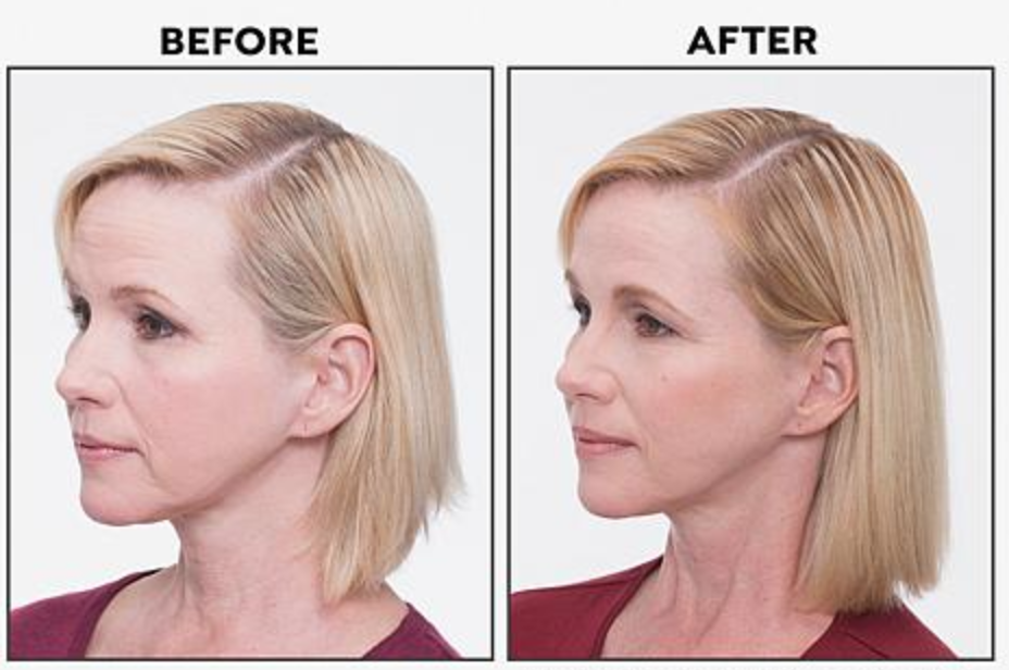 After six months of using the kit, results are noticeable. (Photo: HSN)