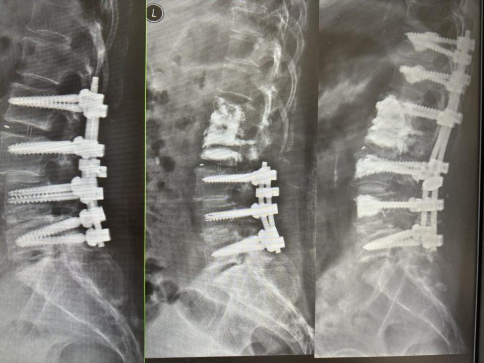 7旬阿嬤7年接受4次腰椎手術，腰椎有如老舊房屋，經接受近11個小時翻修手術，總算告別糾纏多年的病痛。（記者王正平翻攝）