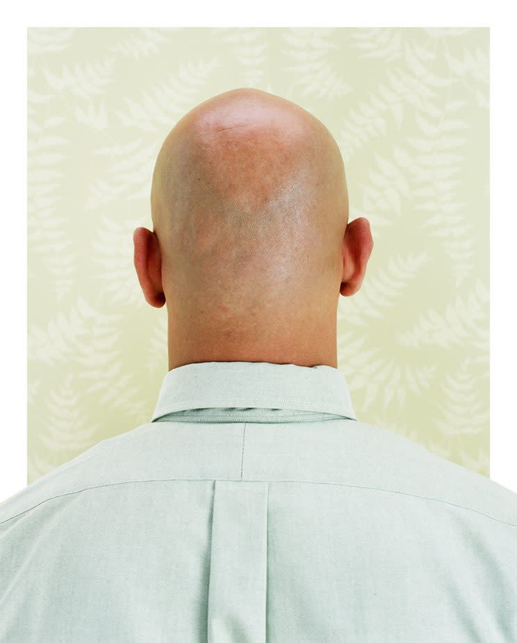 short men bald men genetic study