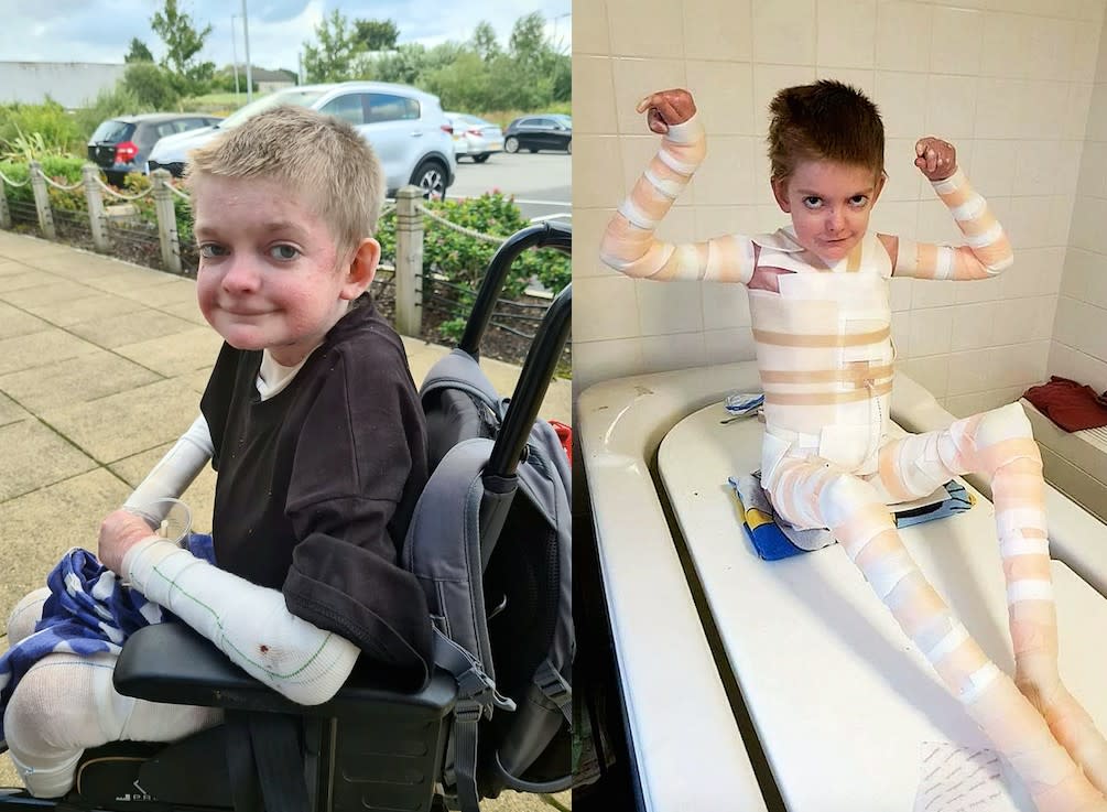 A mum has opened up about her son's rare skin condition. (SWNS)
