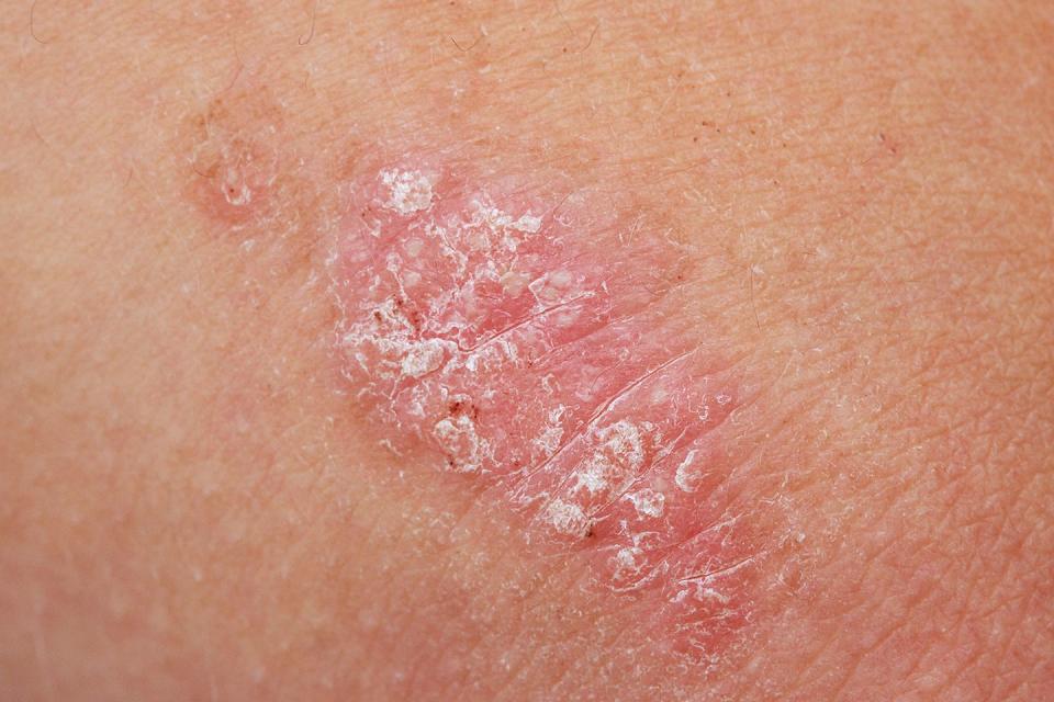 psoriasis