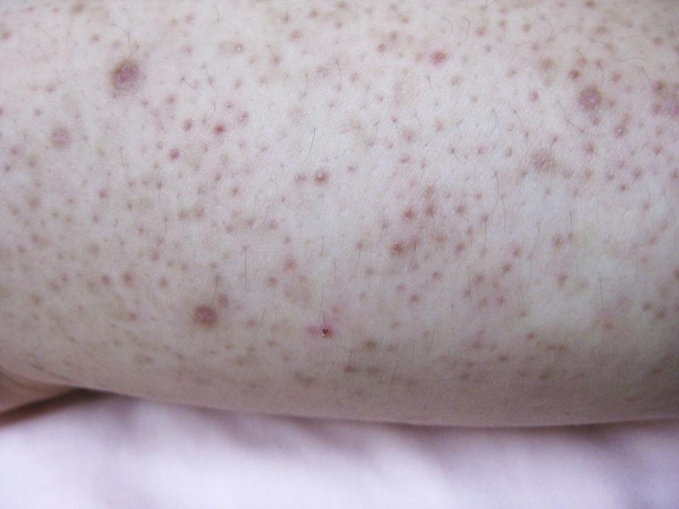 Keratosis pilaris spread over the trunk