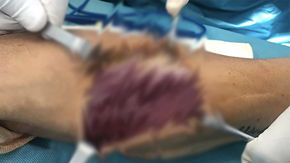 Cal Crutchlow shared images of his surgery (pictured), which her censored on Instagram.