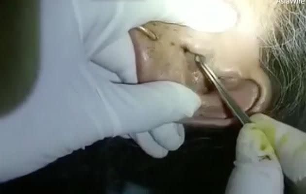 Woman has 30 live maggots pulled from her ear