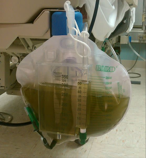 Orina tintada de verde tras seis días de sedación con propofol. (Crédito imagen Wikimedia Commons).