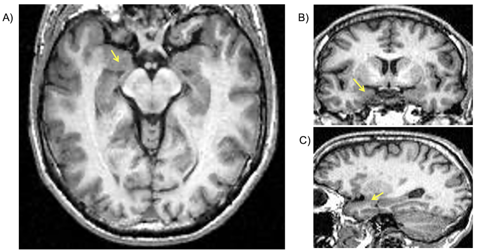 Localización de la amígdala en imágenes de resonancia magnética estructural (mostrada por las flechas amarillas). A) corte axial; B) corte coronal y c) corte sagital.