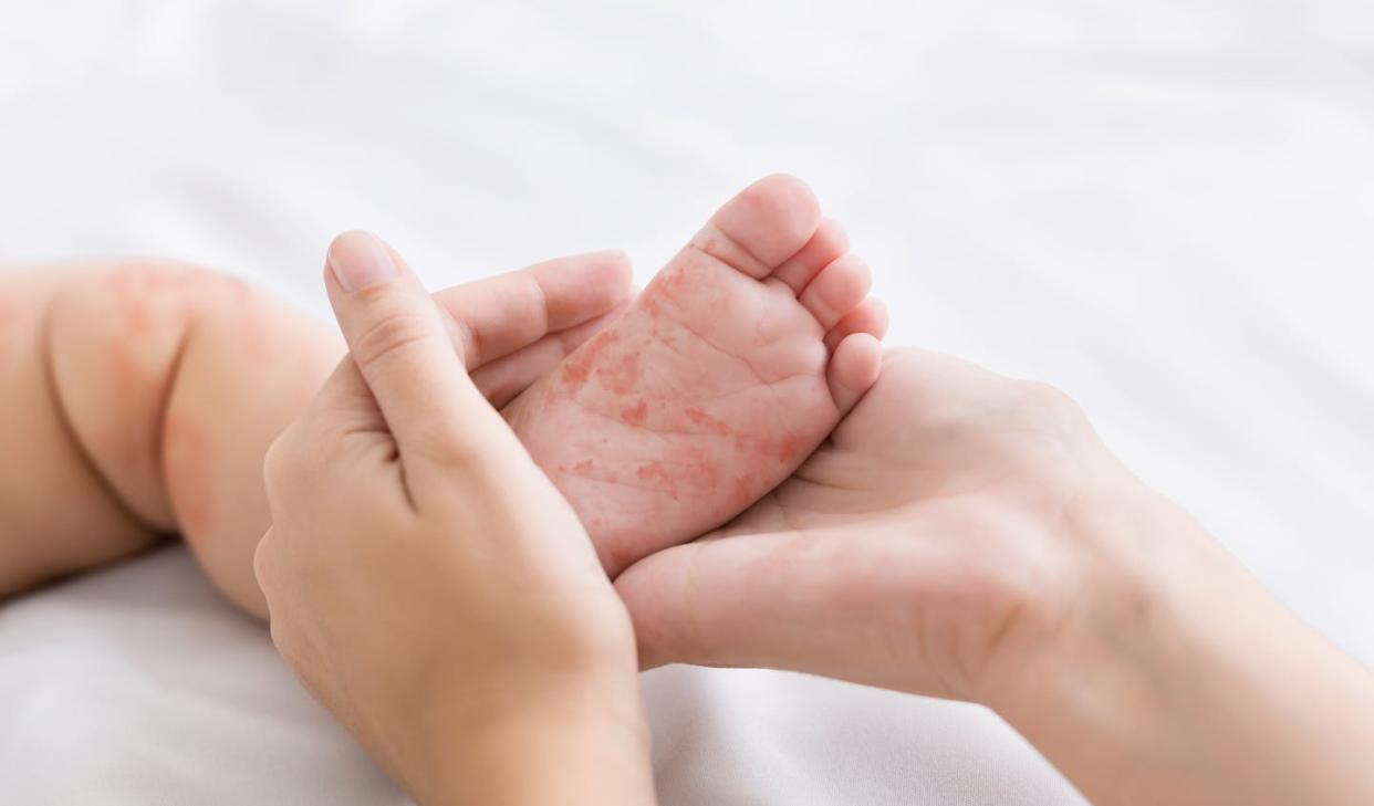 <a href="https://www.shutterstock.com/es/image-photo/measles-virus-mother-holding-tiny-baby-1391758724" rel="nofollow noopener" target="_blank" data-ylk="slk:Prostock-studio / Shutterstock;elm:context_link;itc:0;sec:content-canvas" class="link ">Prostock-studio / Shutterstock</a>