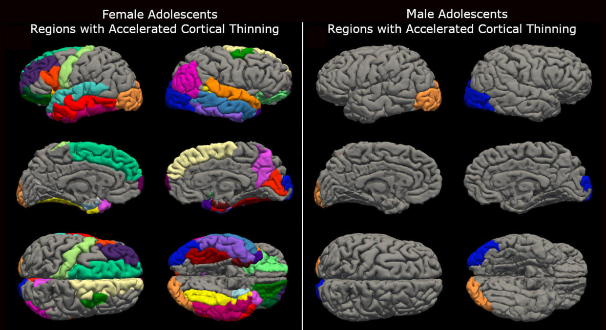 12 different brain drawings showing brain mutations in female and male adolescents (University of Washington's Institute for Learning & Brain Sciences)