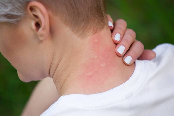 A person with short hair scratches their neck, which is red and has several visible bug bites