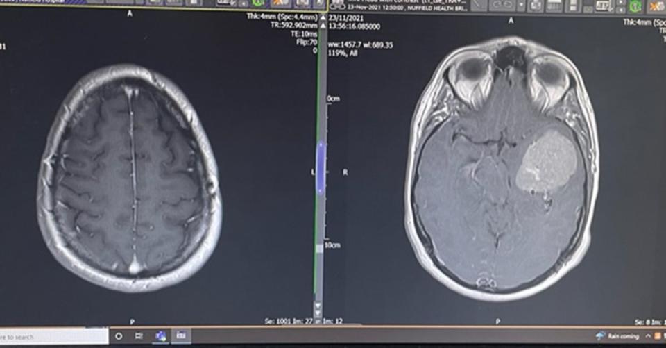 Las radiografías cerebrales de Anna Kane después de la operación (izquierda) y antes de la misma (derecha) (Collect/PA Real Life)