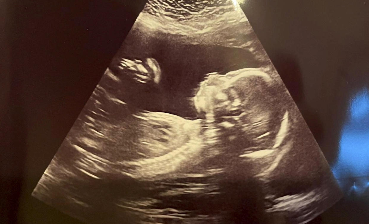 Baby scan. (SWNS)