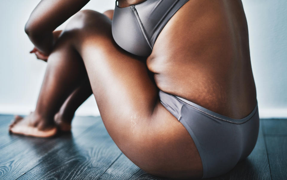 While some embrace their stretch marks others are keen to get rid of theirs. (Getty Images)