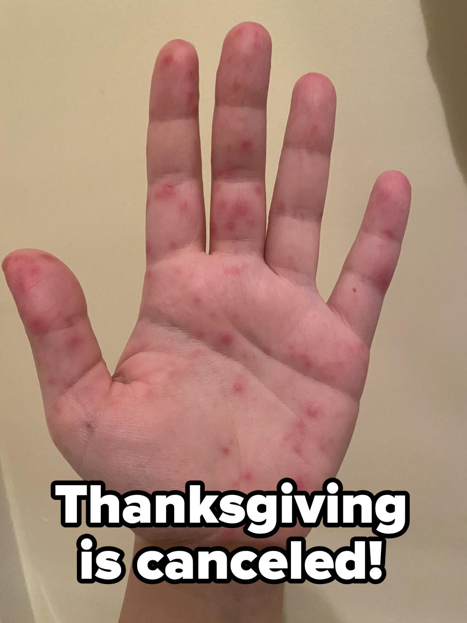 A hand with lesions and red blotches on it with the caption "Thanksgiving is canceled!"