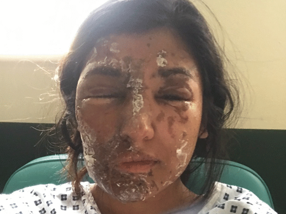 Resham Khan suffered burns to her face and body (GoFundMe)