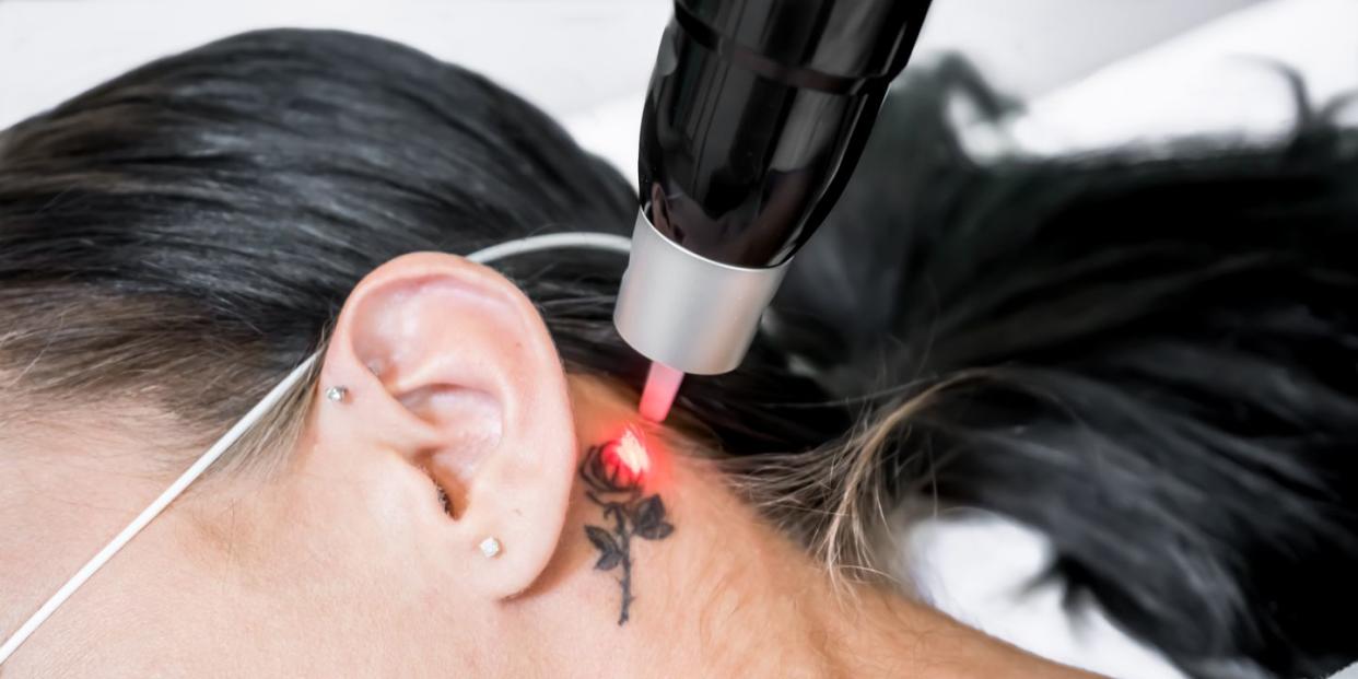 laser tattoo removal treatment session on patient, using picosecond technology, to break down tattoo ink into smaller particles at a beauty and skincare clinic for aesthetic lasers