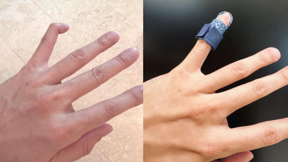 ▼林俊傑左小指「異常彎曲」，需靠輔助器復健6週。（圖／翻攝自林俊傑IG）