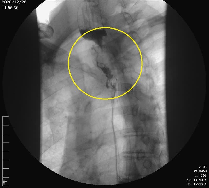 黃圈處為惡性腫瘤堵住食道，導致患者吞嚥困難。（圖／南投醫院提供）