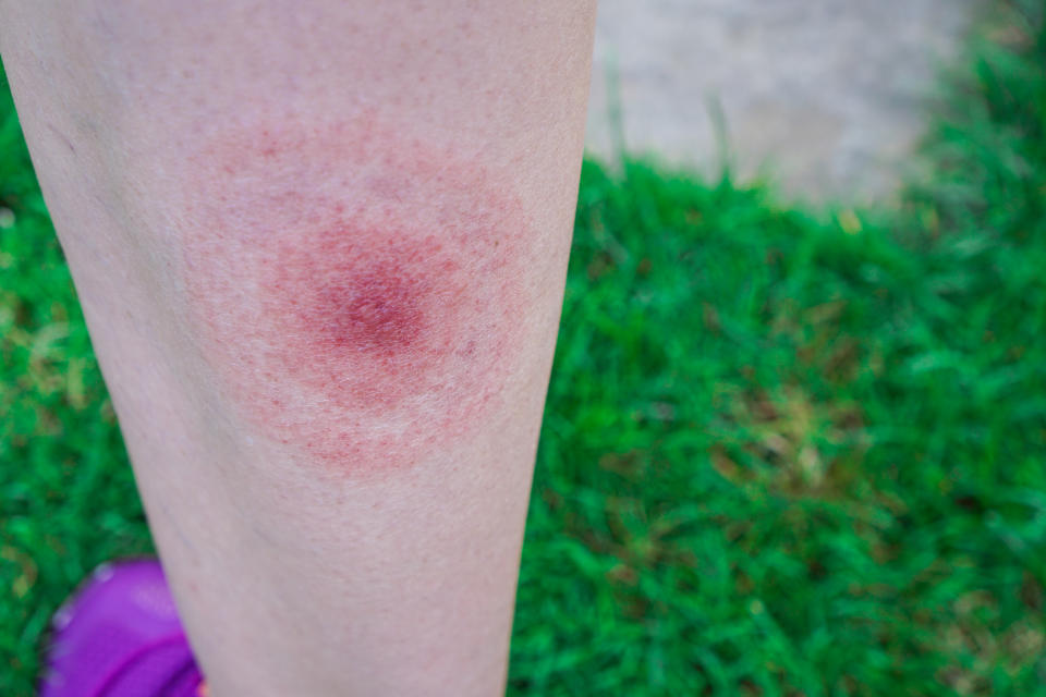 The first symptom of lyme disease is often a bullseye looking rash. (Getty Images)