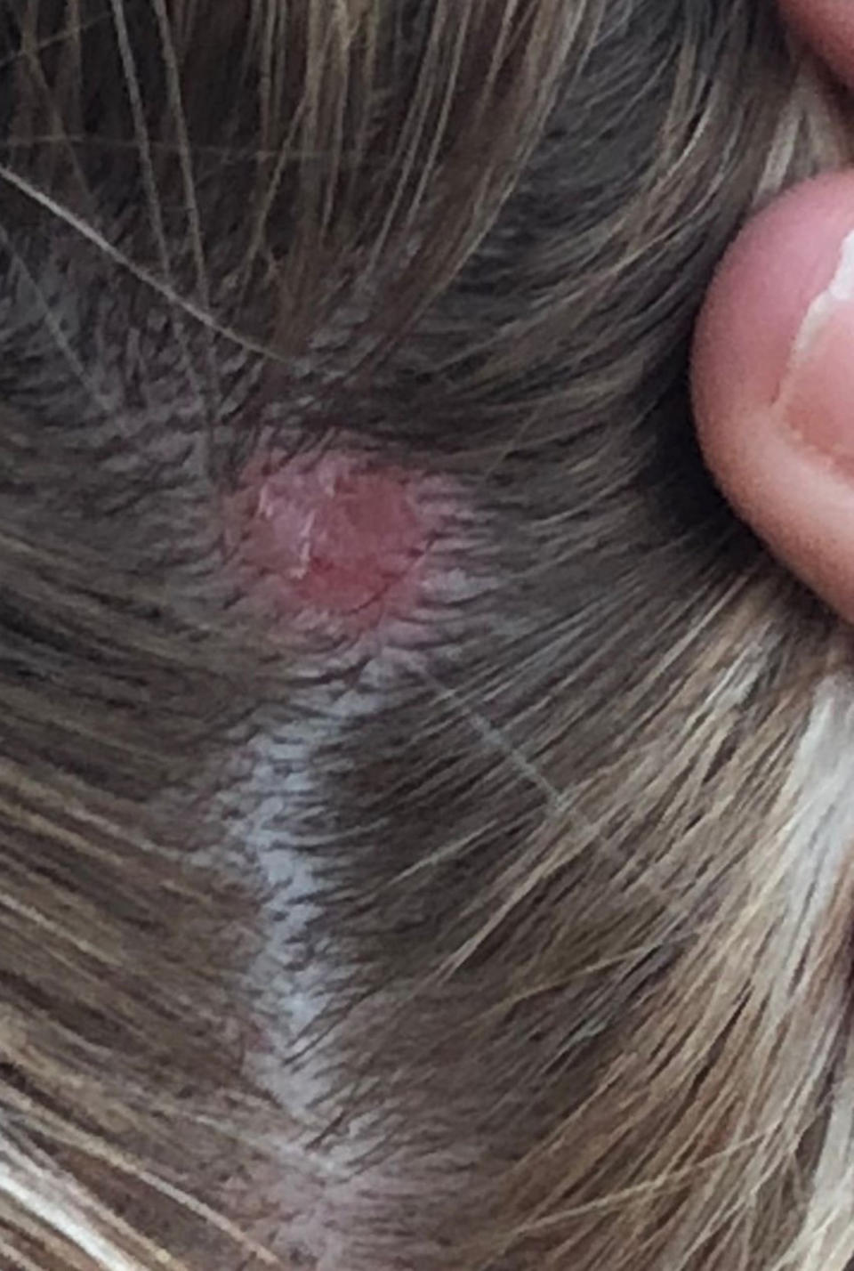 The dry patch that appeared on Murtagh's scalp. (Caters)