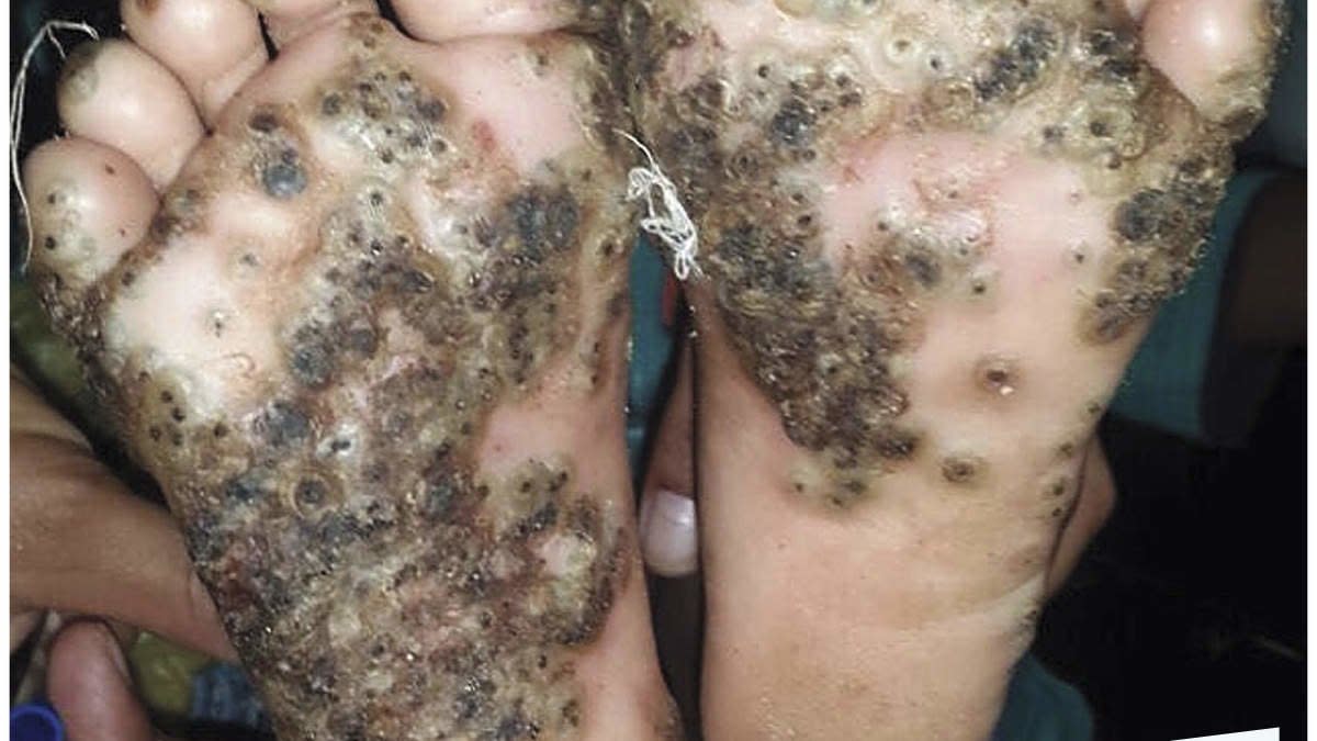 This 10-Year-Old's Feet Were Covered in Green and Black Lesions