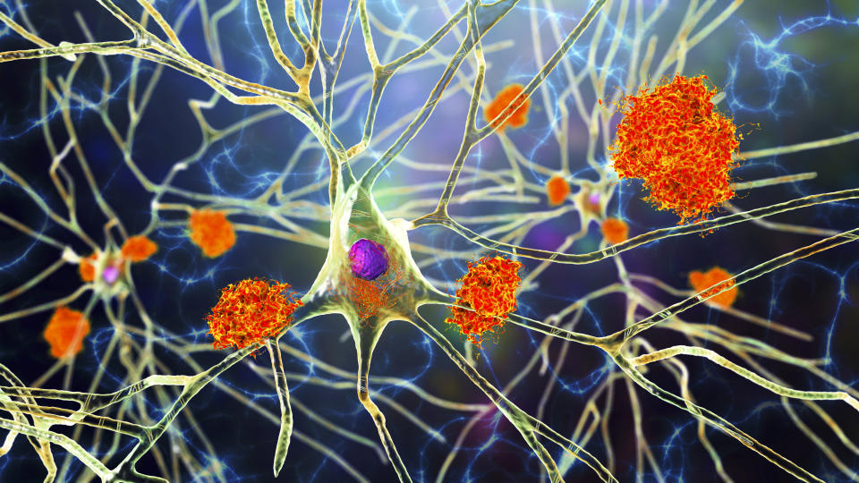 Con el Alzheimer, las proteínas beta-amiloide y tau, afectan progresivamente a las neuronas y otras células cerebrales. (Getty Creative)
