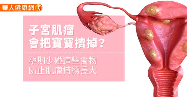 子宮肌瘤會把寶寶擠掉？孕期少碰這些食物防止肌瘤持續長大