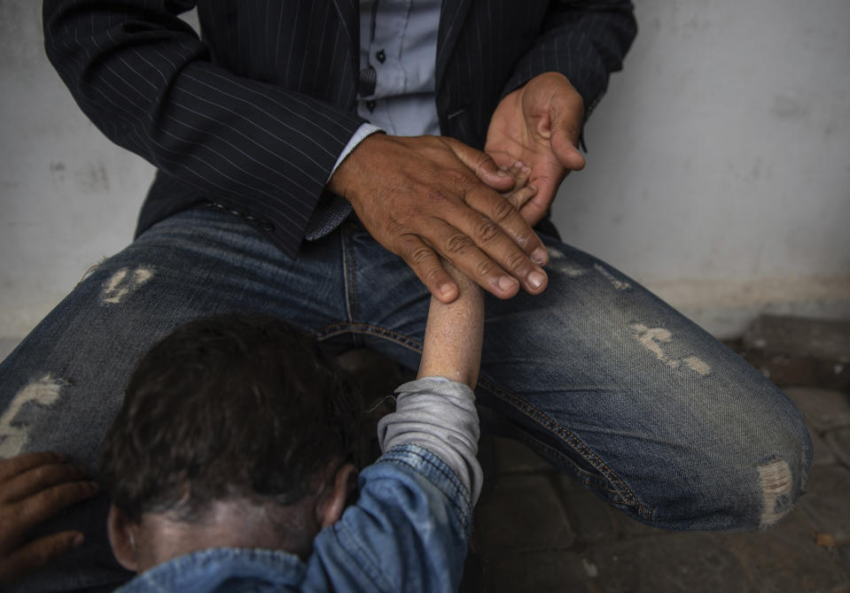 In this Wednesday, July 24, 2019 photo, a father applies cream on the arms and neck of his child who is affected by a rare disorder called xeroderma pigmentosum, or XP, as they wait for a medical consultation in a hospital in Casablanca, Morocco. (AP Photo/Mosa'ab Elshamy)