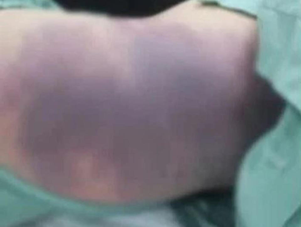 The bruises on the eight-year-old girl who died. Source: Newsflash/Australscope