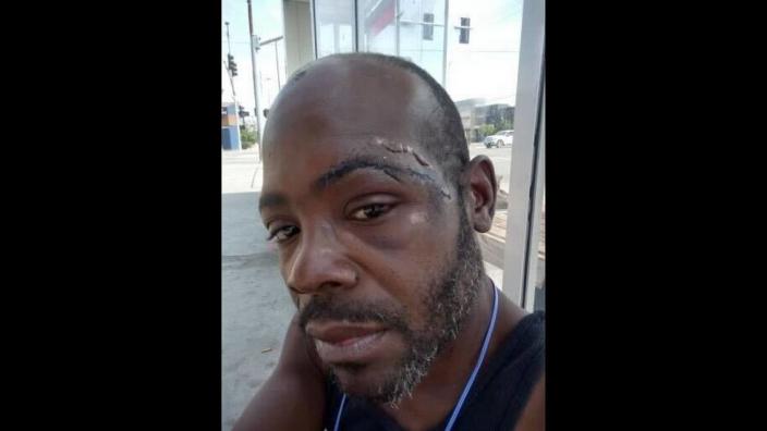 Mack Nelson, 44, takes a photo to show a head injury he received in the early morning hours of Aug. 8 after an officer appears to have thrown him to the ground.