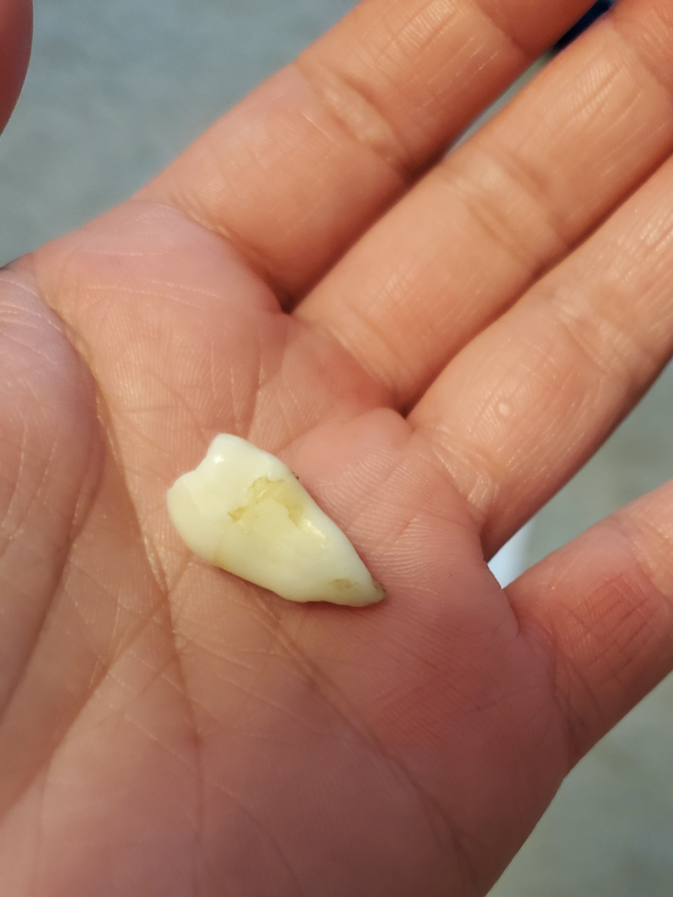 A tooth with just one large root