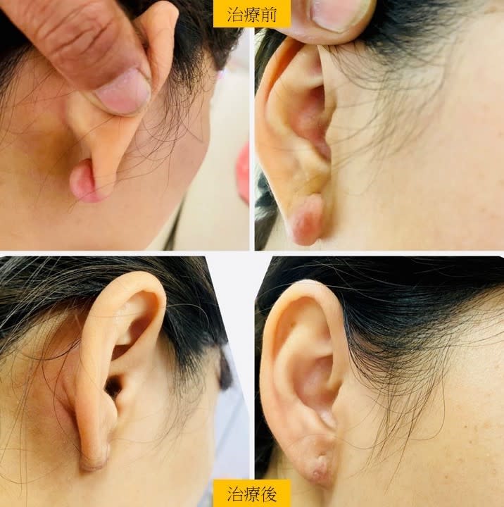 39歲婦人穿耳洞出現蟹足腫（圖上雙耳），經手術切除合併除疤針治療後，恢復正常外觀（圖下）。（安南醫院提供）