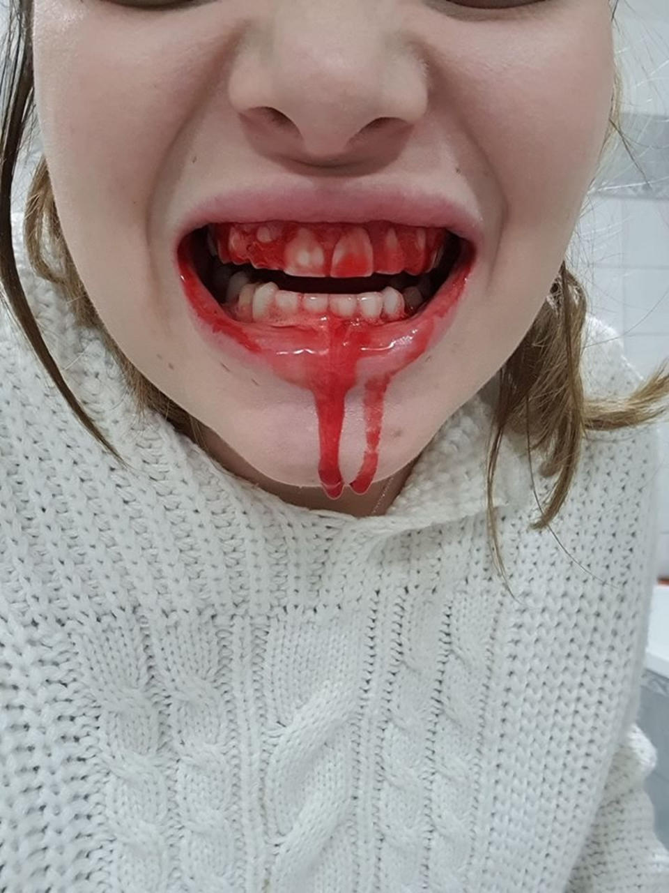 Pic shows: WARNING: GRAPHIC CONTENT  Ella's bloody mouth.  Beautiful blogger Ella Dvornik has shared a snap of her mouth bleeding profusely to show her army of online followers the down side of pregnancy. 