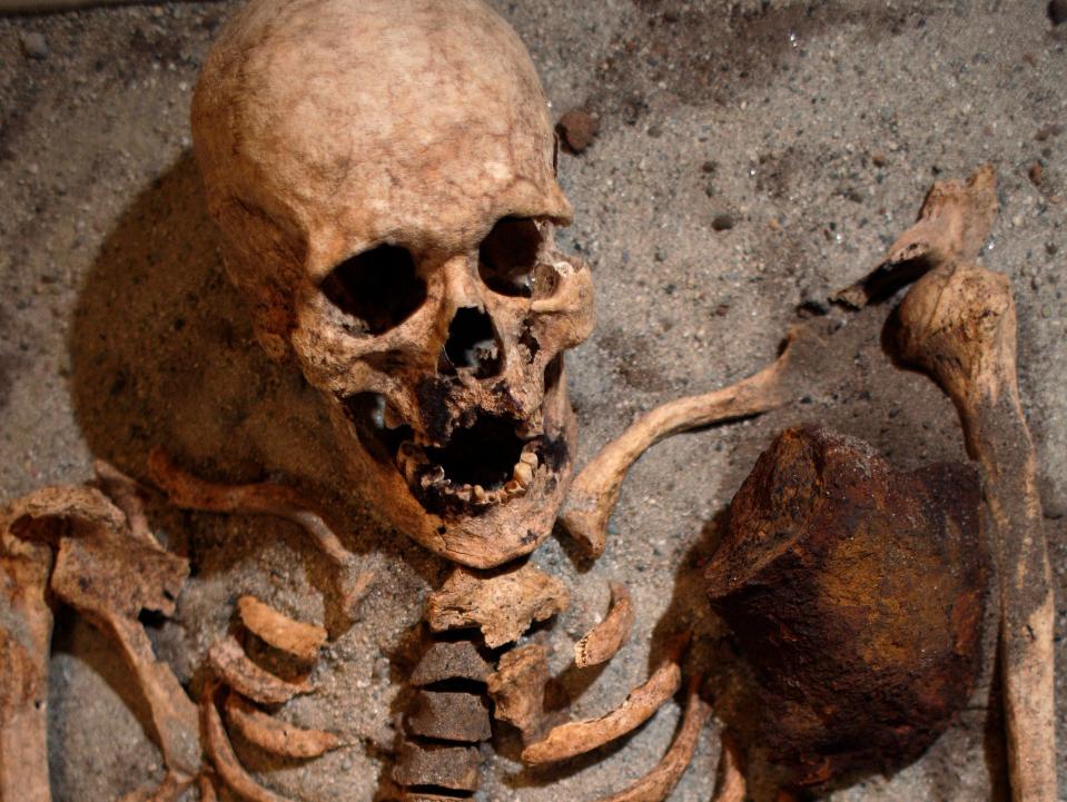 A aged skeleton is seen with a large block of iron placed near its chest under the armpit. Its teeth are missing