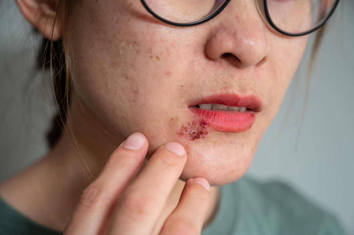 Blisters that break open and form small ulcers, swollen lymph nodes. Herpes simplex virus is an infection that causes herpes.