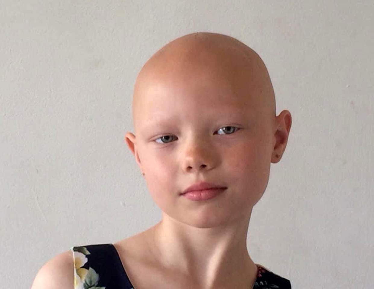 Niamh Lewis, 8, has alopecia but is defying her bullies and embracing her baldness. (Caters)