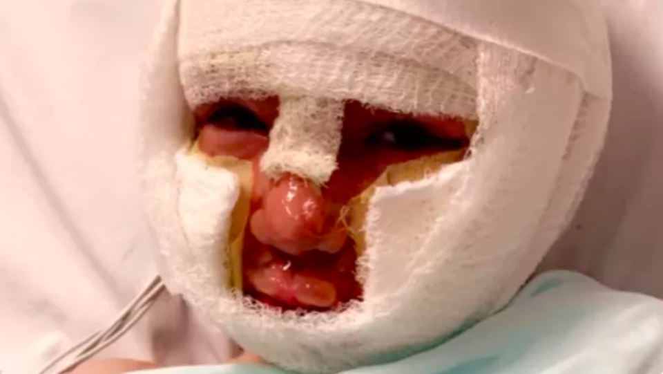 Dominick Krankall is seen in hospital recovering from a dangerous burn incident that left his small limbs and face swollen from injuries (Go Fund Me)