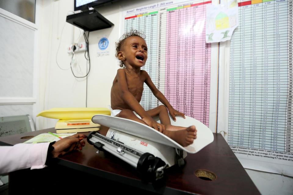 Malnourished Ferial Elias, 2, cries as she is being weighed at a malnutrition treatment ward at al-Thawra hospital in Hodeidah, Yemen: Reuters