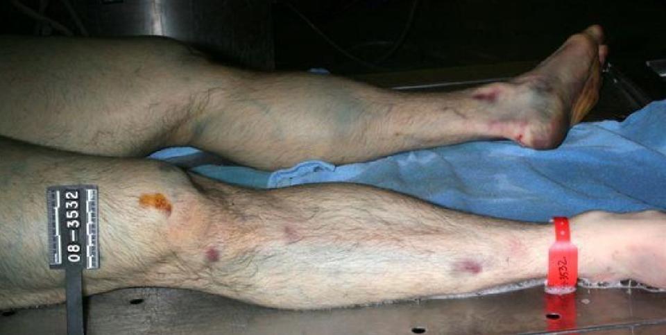 Autopsy photo of Travis Alexander's legs.