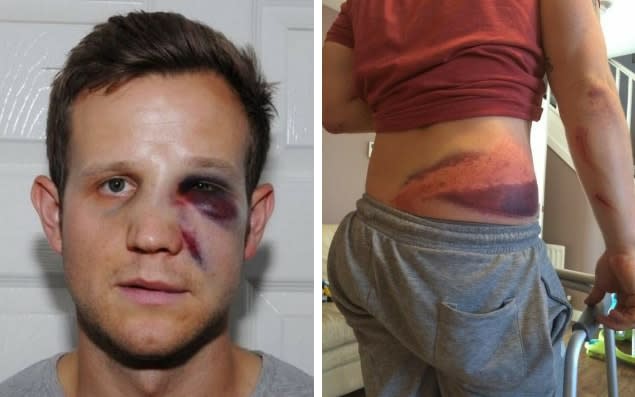 Just some of the injuries suffered by police officers - Essex Police