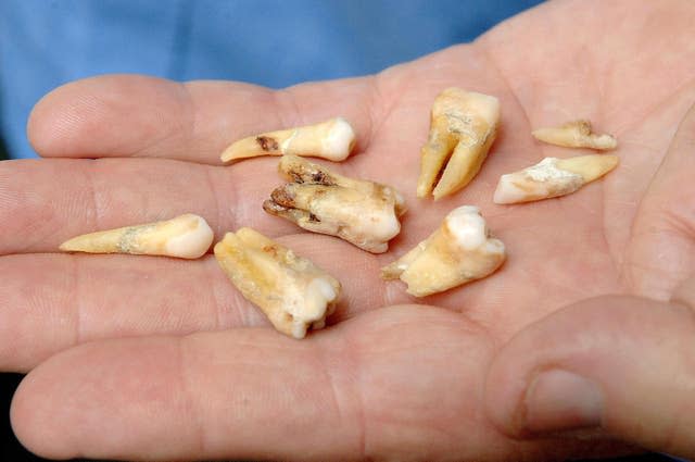 Arthur Haupt holds some of the teeth he pulled out himself using a pair of pliers because he was told to wait for an appointment to see an NHS dentist