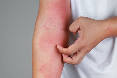 According to the Cleveland Clinic, eczema affects more then 30 million Americans. <a href="https://www.gettyimages.com/detail/photo/eczema-allergy-skin-atopic-dermatitis-royalty-free-image/1270933857?phrase=eczema&adppopup=true" rel="nofollow noopener" target="_blank" data-ylk="slk:tylim/iStock via Getty Images Plus;elm:context_link;itc:0;sec:content-canvas" class="link ">tylim/iStock via Getty Images Plus</a>